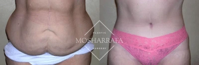 Before and after body lift results showing reduced abdominal laxity and improved waistline