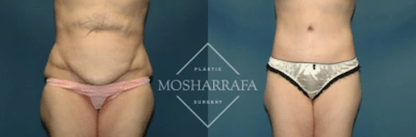 Before and after body lift showing front view abdominal tightening and definition
