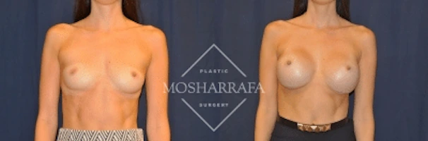 Before and after breast augmentation case, frontal view