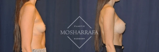 Before and after side-by-side profile view of breast augmentation results