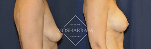 Before and after side profile views of breast augmentation outcomes