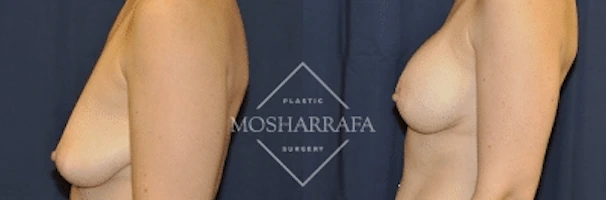 Before and after side profile comparison of breast augmentation results