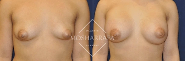 Before and after front view of breast augmentation surgical results