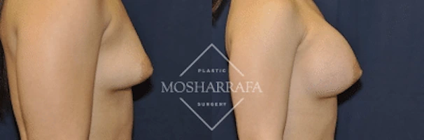 Before and after side profile views showing breast augmentation transformation