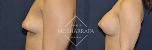 Before and after side profile comparison of breast augmentation results