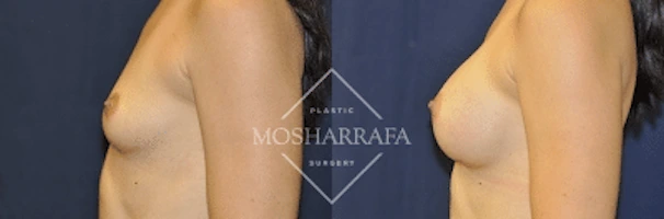 Before and after side profile comparison of breast augmentation results