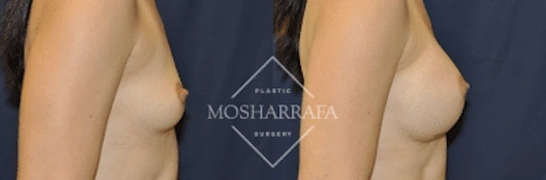 Before and after side profile comparison of breast augmentation results