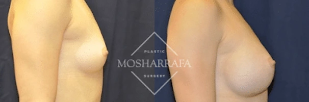 Before and after side profile comparison of breast augmentation results