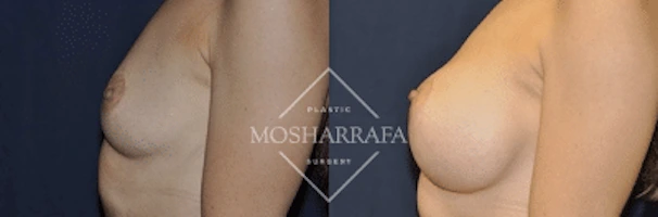 Before and after breast augmentation results shown from side view