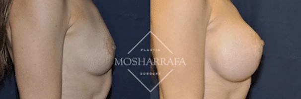 Before and after breast augmentation results shown from side view
