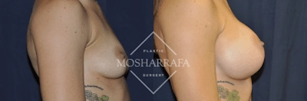 Before and after breast augmentation results shown from side view