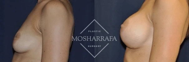 Before and after breast augmentation results shown from side view