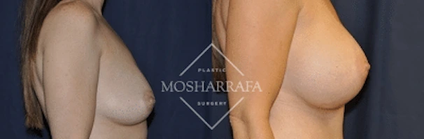 Breast augmentation before and after, side view