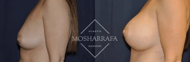 Breast augmentation before and after, angled side view