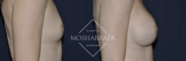 Breast augmentation before and after, side view