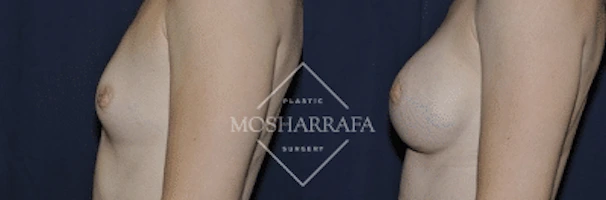 Breast augmentation before and after, angled side view