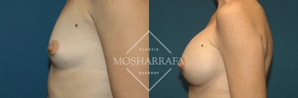 Before and after breast augmentation, side view comparison