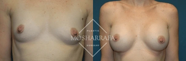 Before and after breast augmentation, front view comparison