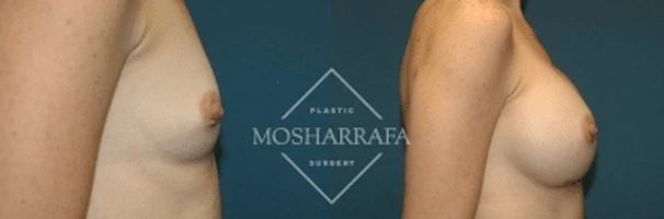 Before and after breast augmentation, side profile comparison