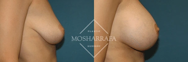 Before and after breast augmentation, side view comparison