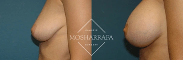 Before and after breast augmentation, side profile comparison
