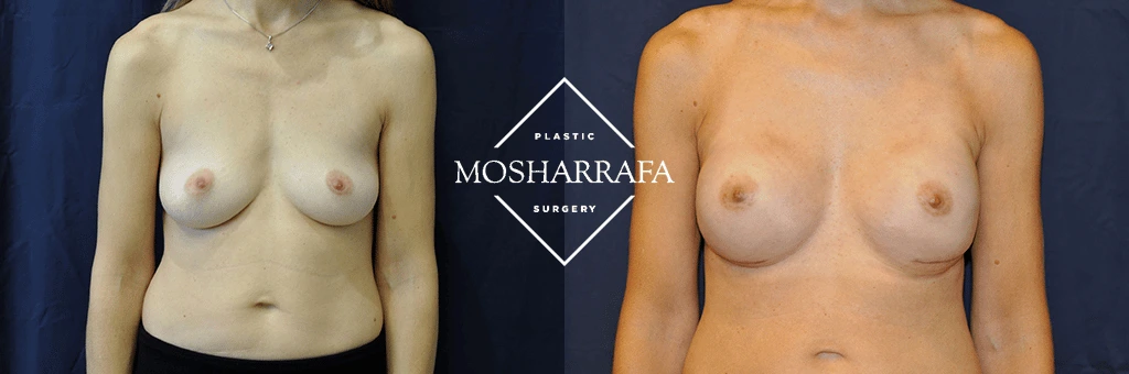 Before and after breast augmentation, frontal view
