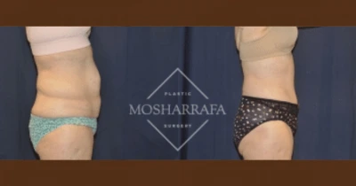 Before and after liposuction results showing side view of waist and hip contour