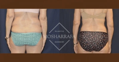 Before and after case 135 comparison showing frontal torso view of body contouring results