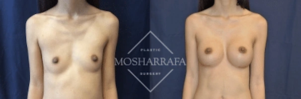 Before and after breast augmentation, frontal view