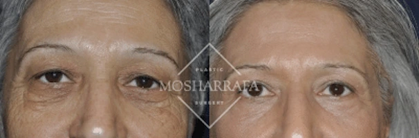 Before and after frontal close-up of patient's eyes and forehead area
