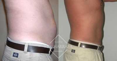 Before and after of patient's torso showing reduced midsection fullness and improved abdominal definition