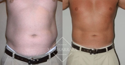 Before and after of patient's abdomen showing flattened midsection and enhanced core definition