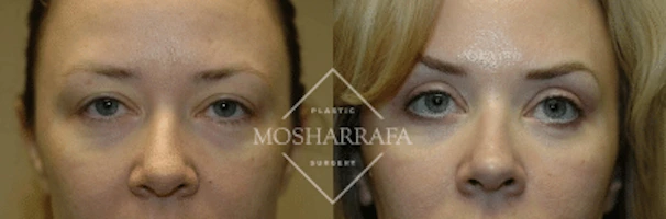 Before and after frontal facial views showing case 183 results