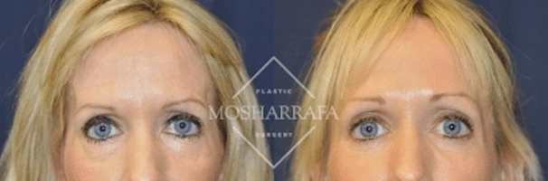 Front-facing before and after comparison of patient's upper face and eye area