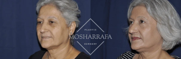 Before and after three-quarter view of female patient showing facial rejuvenation outcomes