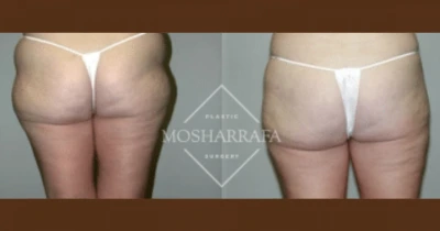 Before and after of patient's buttocks and lower body showing improved shape and contour