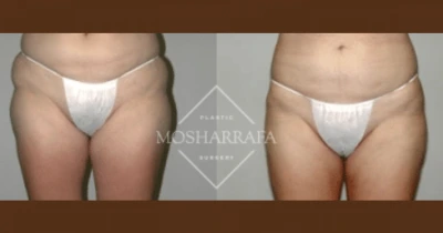Before and after of patient's lower abdomen and thighs showing enhanced body contour and definition