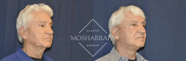 Before and after side profile comparison of an older man's face showing results of facelift surgery