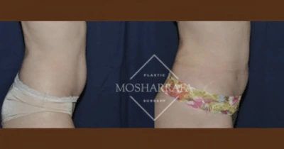 Before and after liposuction results showing side view of waist and abdomen