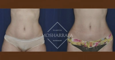 Before and after liposuction results showing front view of abdomen and waistline