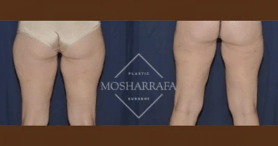 Before and after liposuction results showing back view of buttocks and thighs