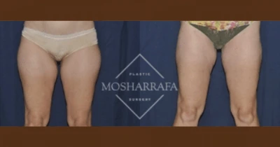Before and after liposuction results showing front view of lower abdomen and thighs