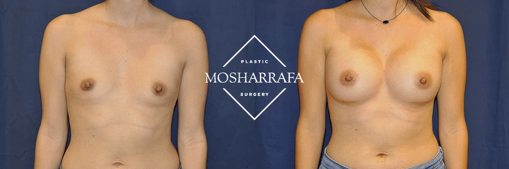 Before and after frontal view of breast augmentation case 24