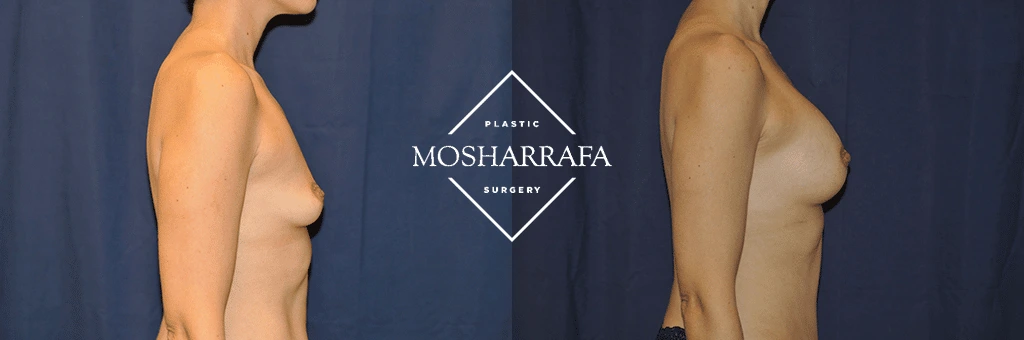 Before and after profile view of breast augmentation case 25