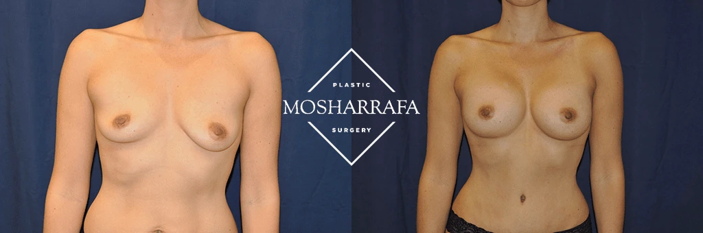 Before and after frontal view comparison of breast augmentation results