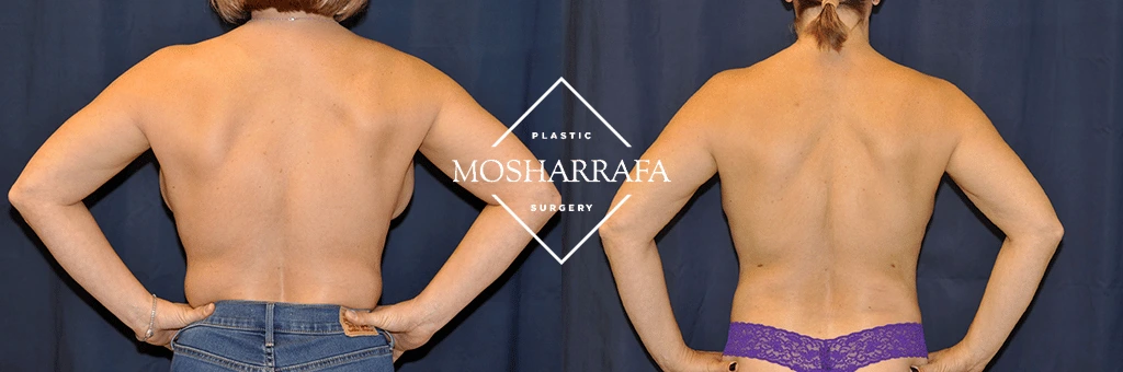 Before and after rear view of back showing body contouring results