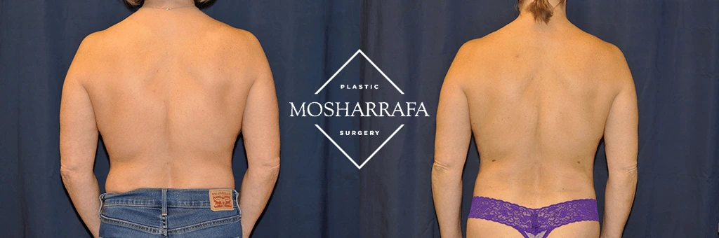 Before and after rear view of back and lower torso showing body contouring results