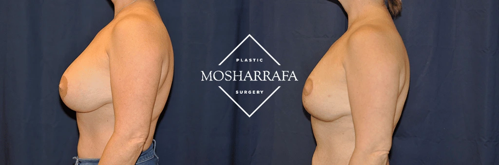 Before and after side view of torso showing body contouring results