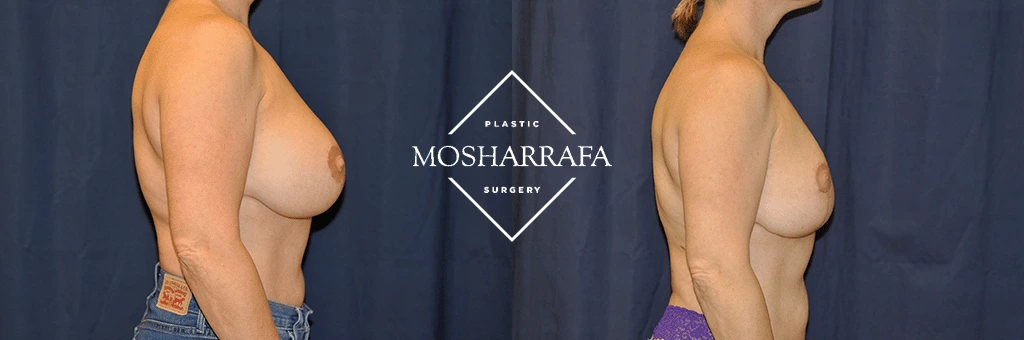 Before and after side profile comparison of breast augmentation results at Mosharrafa Surgery