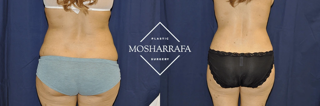 Before and after abdominal liposuction results, front view comparison